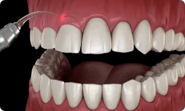 Gum Contouring