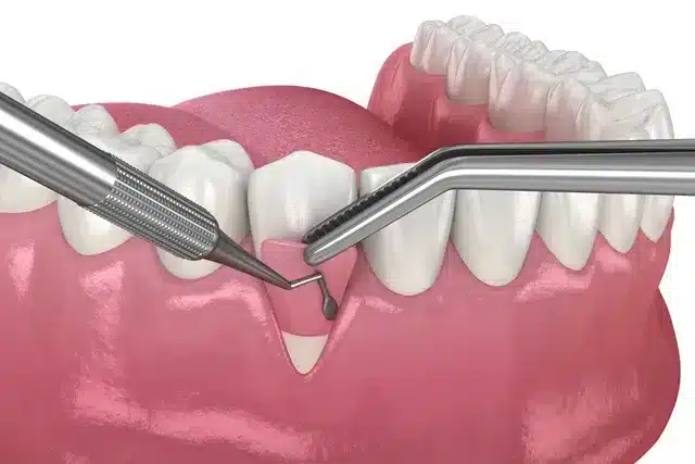 Tissue Grafting