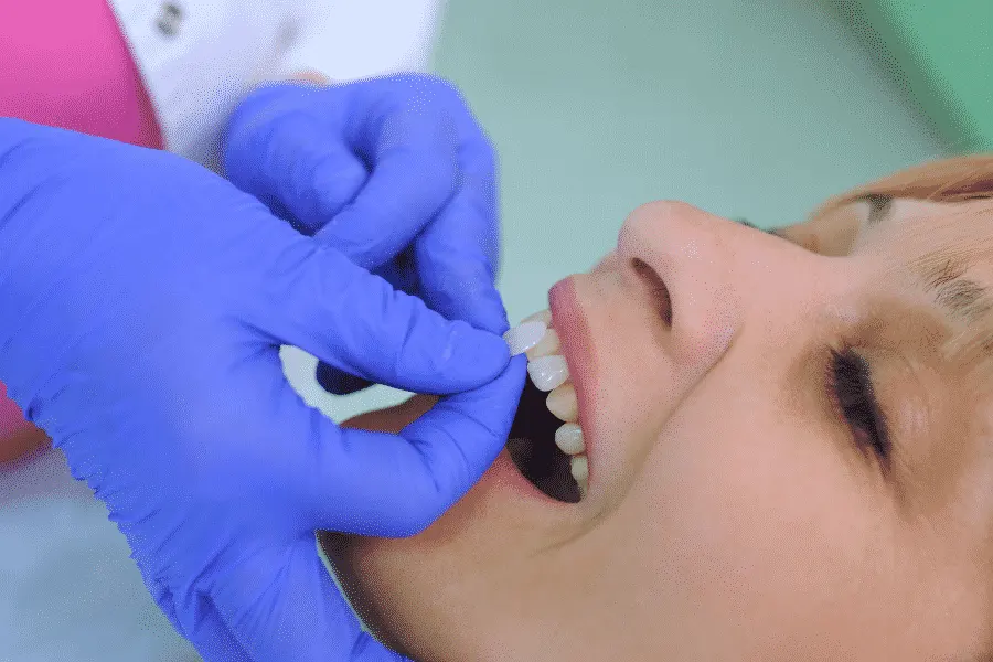 Porcelain Veneers