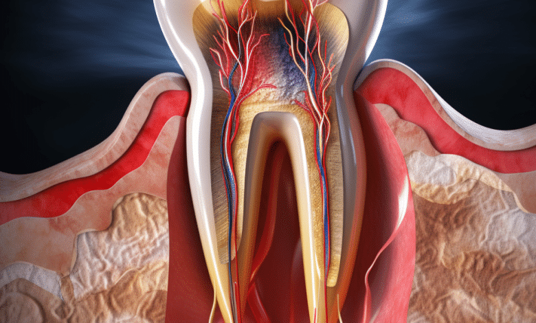 Root Canal