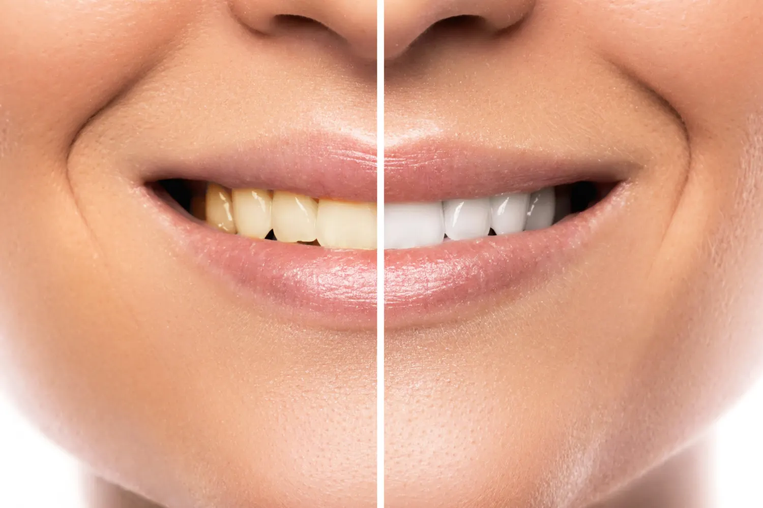 teeth whitening second