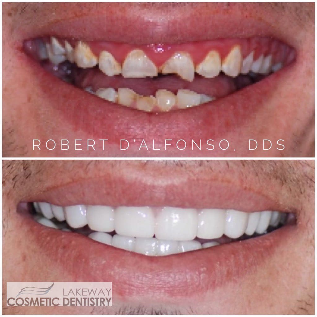 Before and after smile makeover - Lakeway Cosmetic & Family Dentistry, Lakeway, Texas