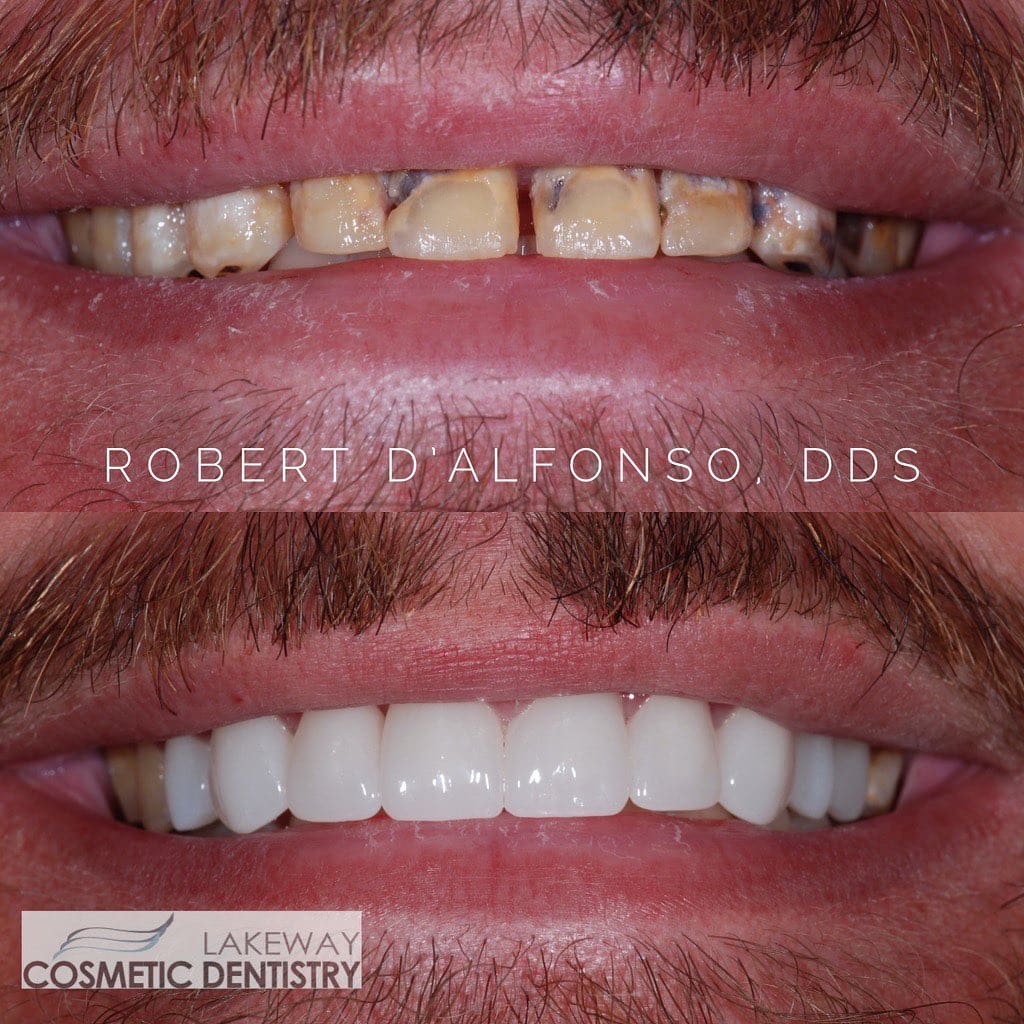 Before and after smile makeover - Lakeway Cosmetic & Family Dentistry, Lakeway, Texas 2