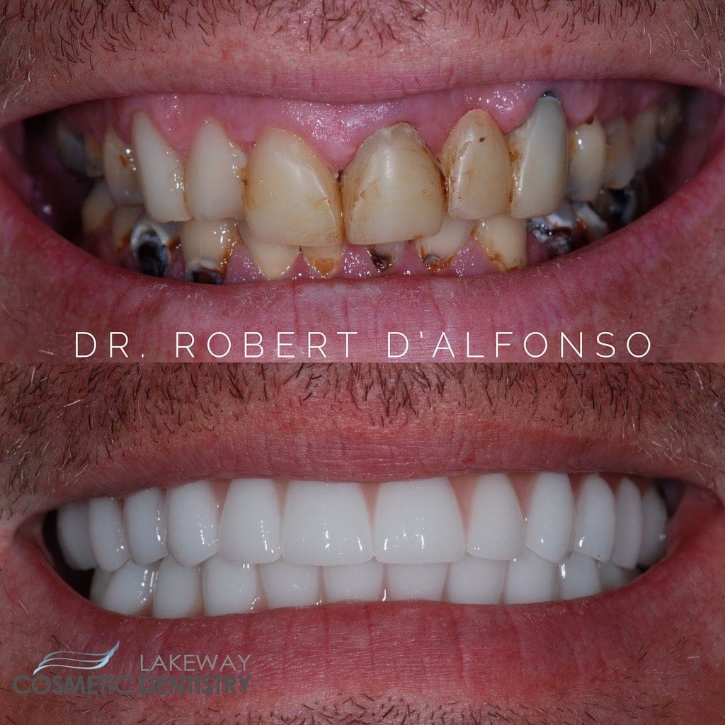 Before and after smile makeover - Lakeway Cosmetic & Family Dentistry, Lakeway, Texas 3
