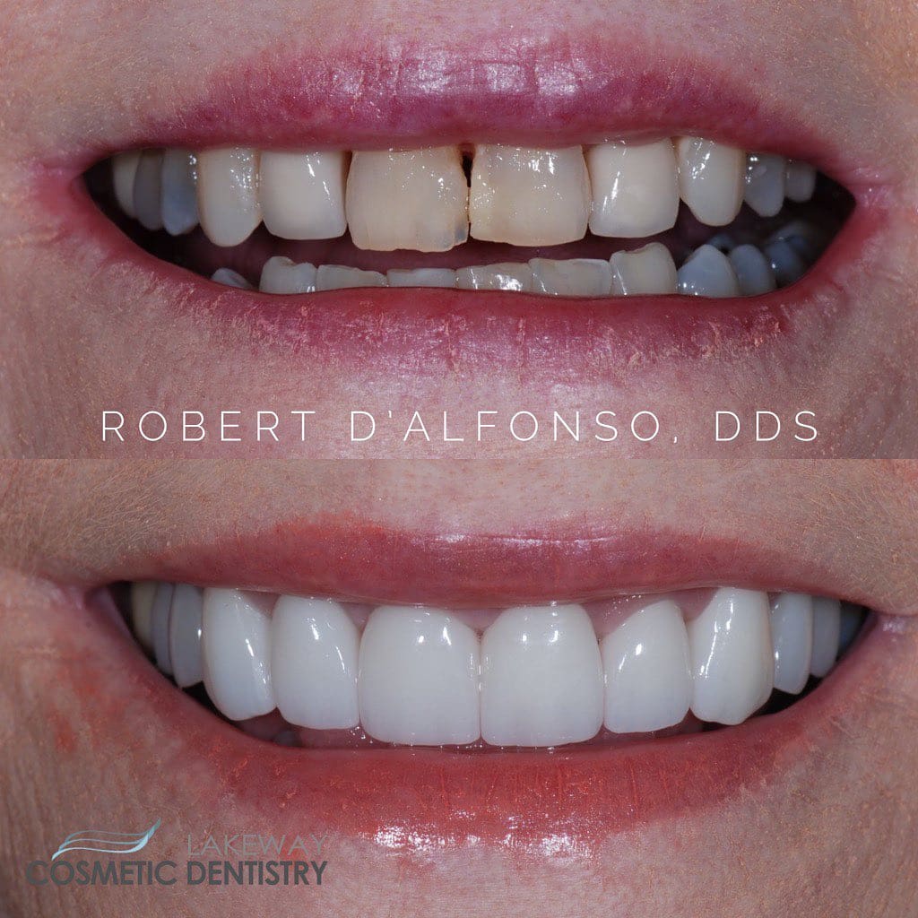 Before and after smile makeover - Lakeway Cosmetic & Family Dentistry, Lakeway, Texas 4