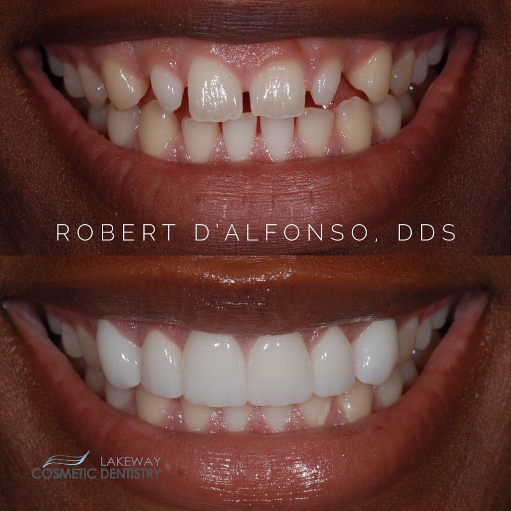 Before and after smile makeover - Lakeway Cosmetic & Family Dentistry, Lakeway, Texas 6