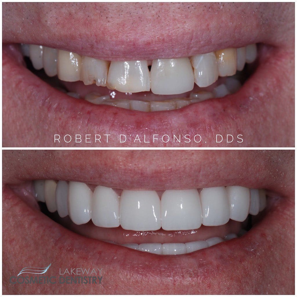 Before and after smile makeover - Lakeway Cosmetic & Family Dentistry, Lakeway, Texas 5