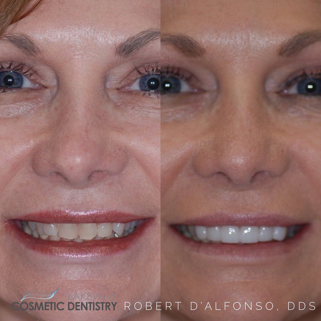 Before and after smile makeover - Lakeway Cosmetic & Family Dentistry, Lakeway, Texas 9