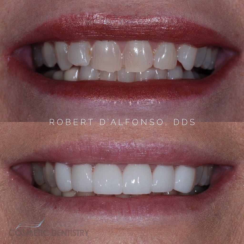 Before and after smile makeover - Lakeway Cosmetic & Family Dentistry, Lakeway, Texas 7