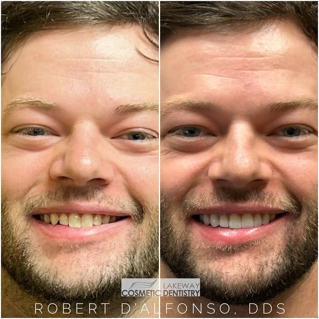 Before and after smile makeover - Lakeway Cosmetic & Family Dentistry, Lakeway, Texas 11
