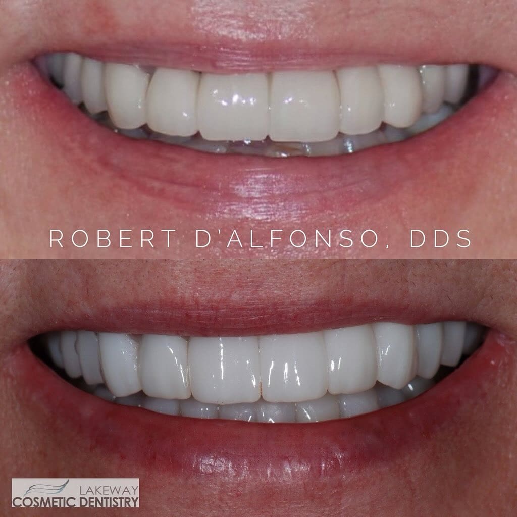 Before and after smile makeover - Lakeway Cosmetic & Family Dentistry, Lakeway, Texas 14