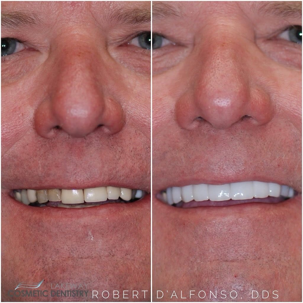 Before and after smile makeover - Lakeway Cosmetic & Family Dentistry, Lakeway, Texas 10