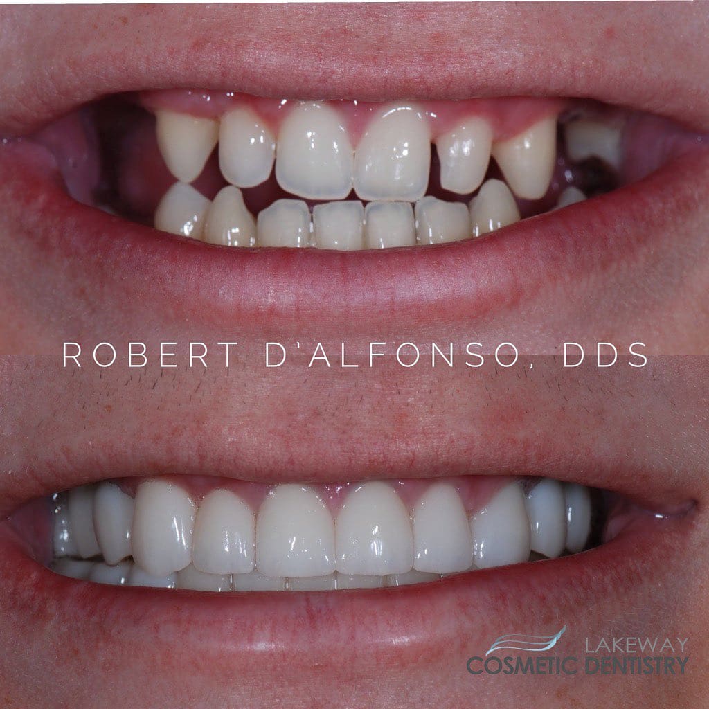 Before and after smile makeover - Lakeway Cosmetic & Family Dentistry, Lakeway, Texas 8