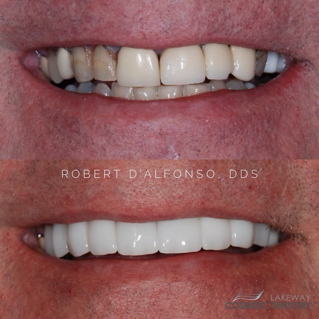 Before and after smile makeover - Lakeway Cosmetic & Family Dentistry, Lakeway, Texas 13