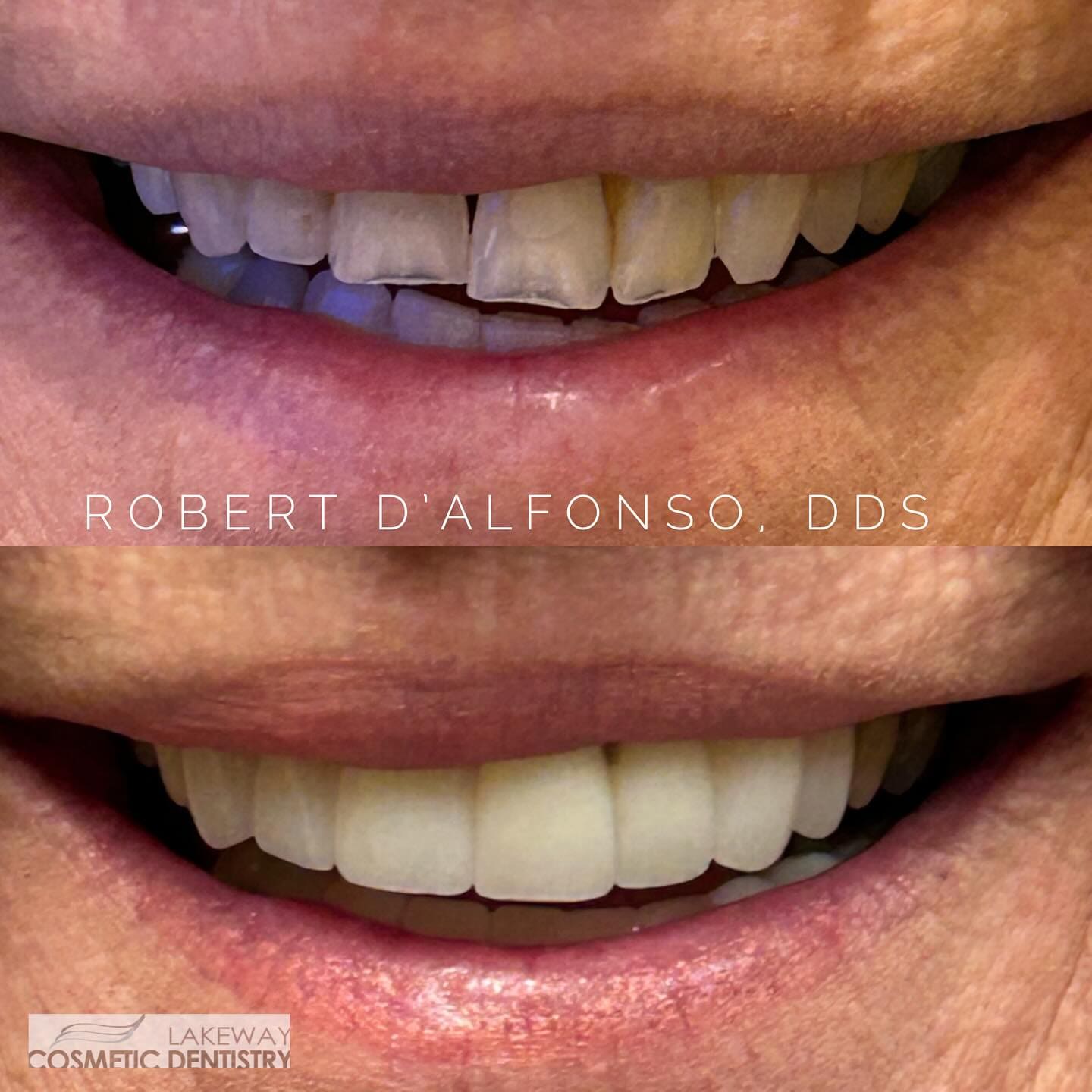 Before and after smile makeover - Lakeway Cosmetic & Family Dentistry, Lakeway, Texas 15
