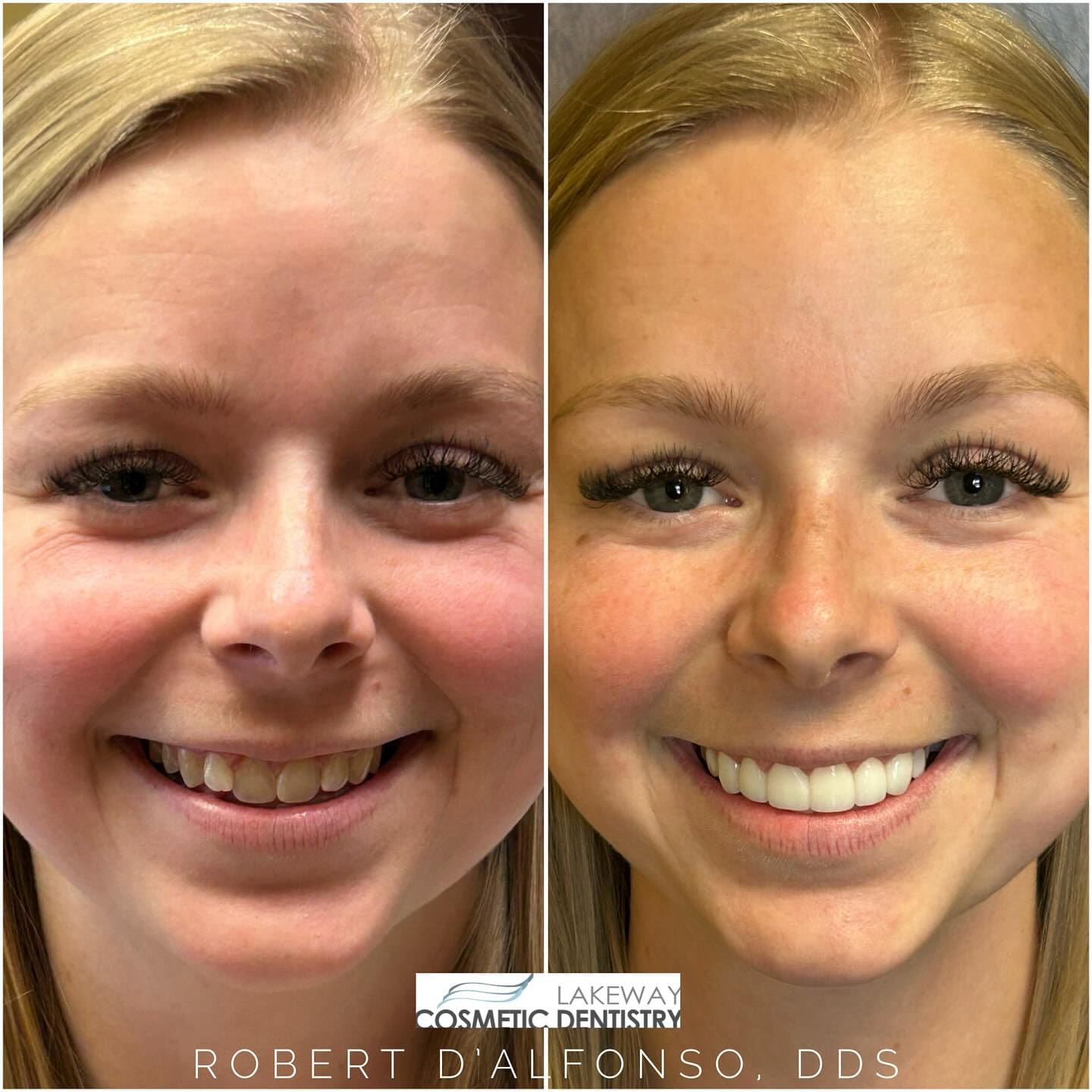Before and after smile makeover - Lakeway Cosmetic & Family Dentistry, Lakeway, Texas 12