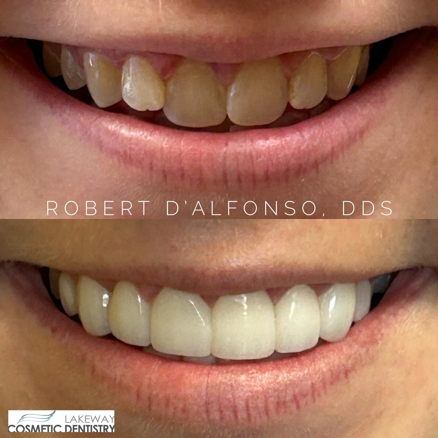Before and after smile makeover - Lakeway Cosmetic & Family Dentistry, Lakeway, Texas 16